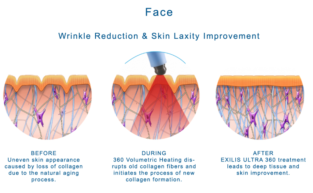 دستگاه BTL Aesthetics - Exilis Ultra 360